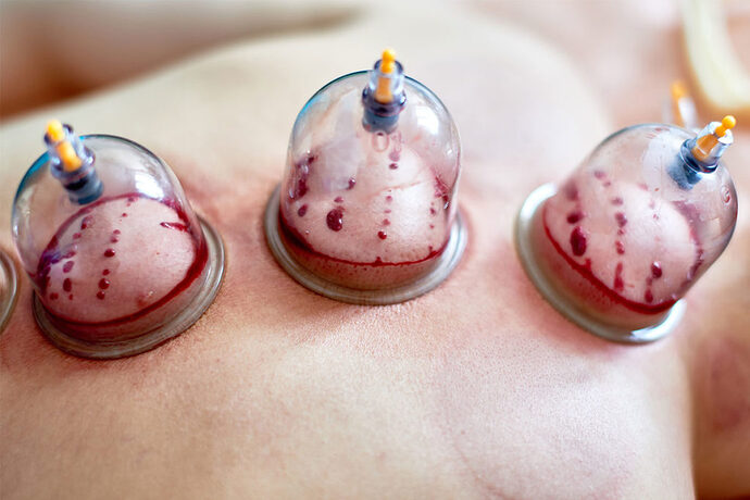 HijamaSunnahBloodCupping-1024x683